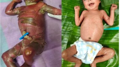 सुदूर बीजापुर में चिकित्सा चमत्कार : अत्यंत दुर्लभ बीमारी से जूझते शिशु को बचाया….